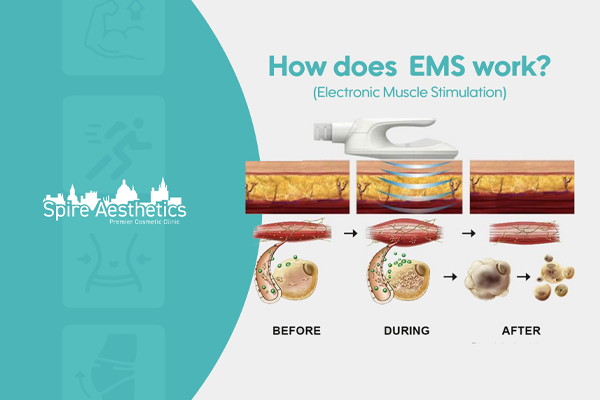EMS treatment for post pregnancy weight loss treatment Kingston-upon-Hull