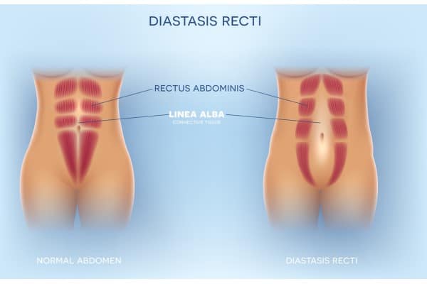What Non-Surgical Options Are Available for Diastasis Recti Kingston-upon-Hull?
