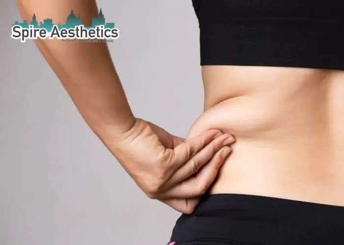 Image of woman pinching fat on their hips Kingston-upon-Hull. Fat Freezing treatment 