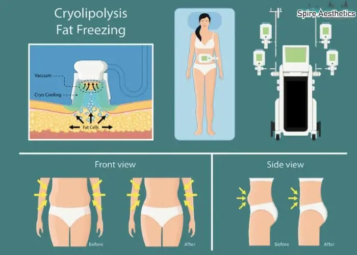Fat freezing treatment Kingston-upon-Hull benefits for competitions to remove stubborn fat deposits.