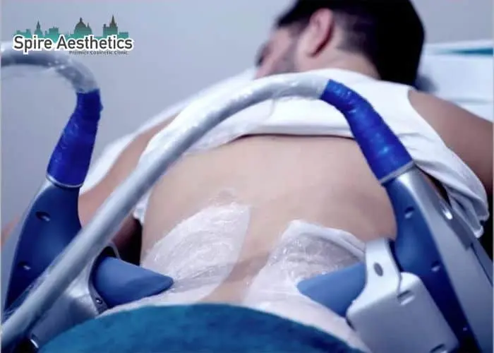Man having fat freezing treatment done on love handles before a competitions Kingston-upon-Hull to create a sculpted look.