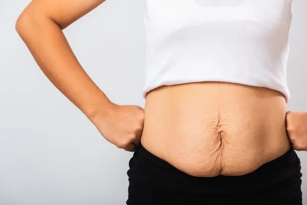 Image of a woman's stomach after weight loss with sagging skin following a gastric band Kingston-upon-Hull