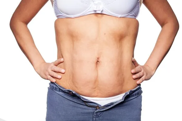 sagging skin on woman's stomach after weight loss injections Kingston-upon-Hull