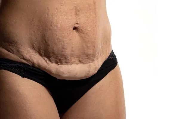 Image of womans stomach after weight loss injections Kingston-upon-Hull showing saggy skin