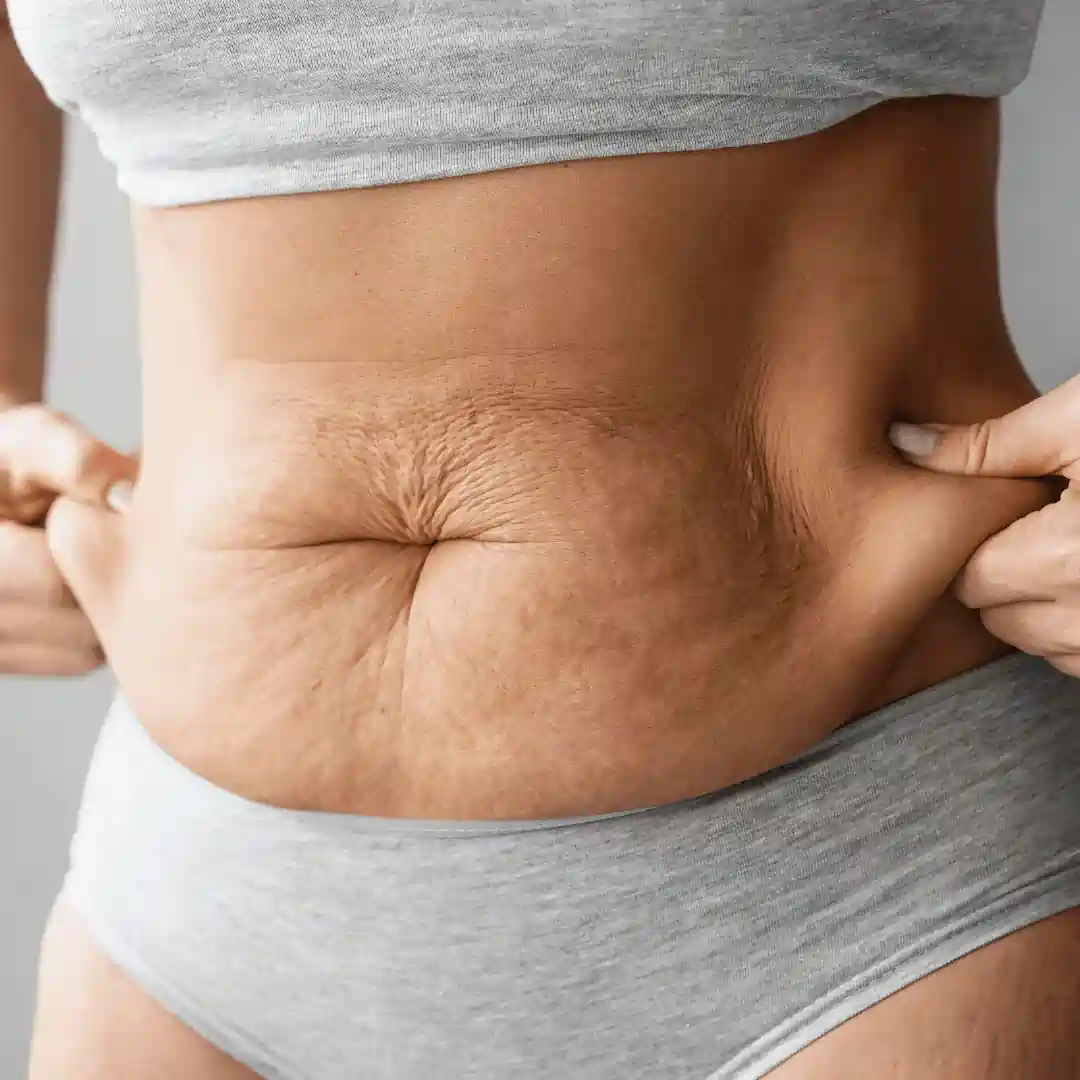 Is It Normal to Have Loose Skin After Pregnancy Kingston-upon-Hull?