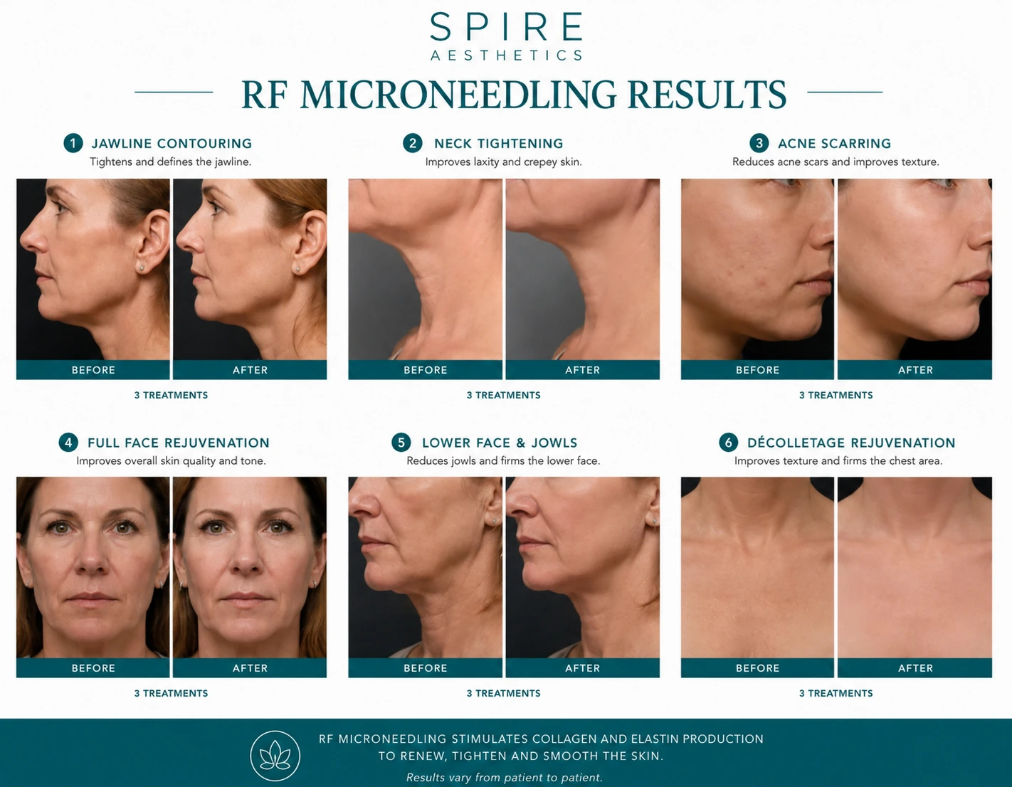 RF Microneedling Skin tightening Kingston-upon-Hull results