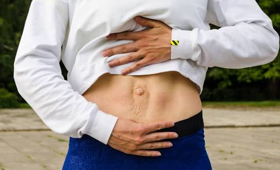 When Could Diastasis Recti Be the Missing Piece of the Puzzle Kingston-upon-Hull?