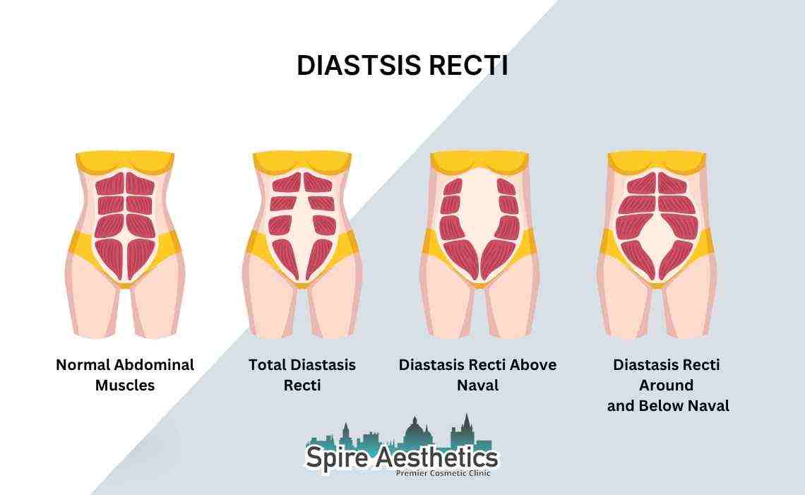 Is Non-Surgical Diastasis Recti Treatment Right for You? Common Concerns Answered Kingston-upon-Hull